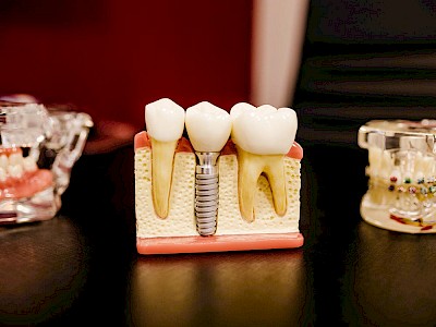 Zahnmodelle zur Veranschaulichung der Inhaltspunkte des Themas SEO für Zahnärzte